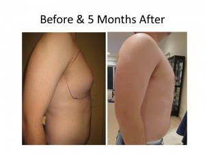 Male Breast Reduction