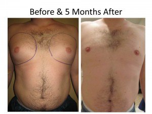 Male Breast Reduction Before After