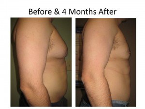 Treatment for Gynecomastia