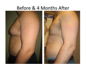 Before and After Gynecomastia Treatment