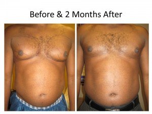 Gynecomastia Treatment