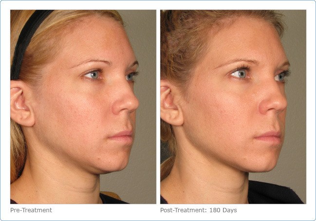 Ultherapy-Before-and-After-10