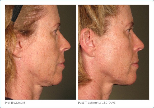 Ultherapy-Before-and-After-11