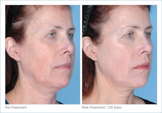 Ultherapy-Before-and-After-13