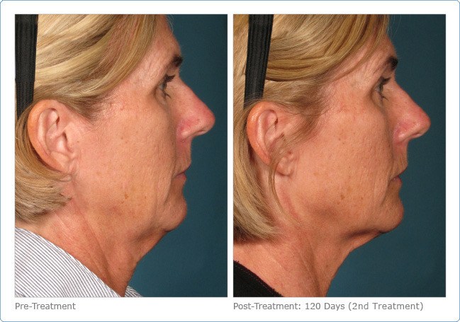 Ultherapy-Before-and-After-1