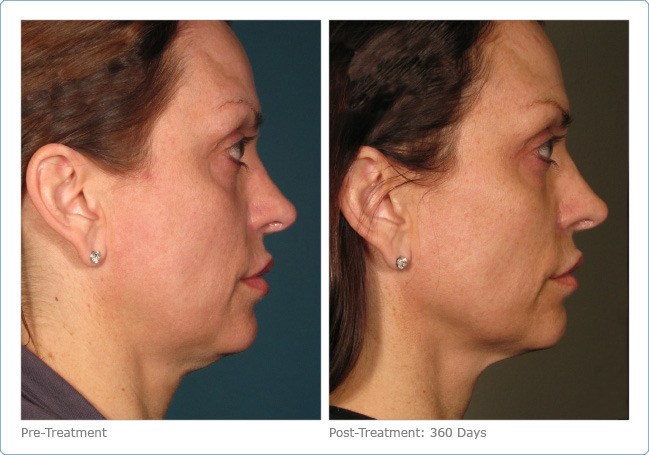 Ultherapy-Before-and-After-2