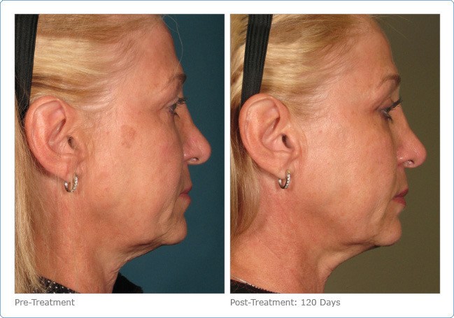 Ultherapy-Before-and-After-3