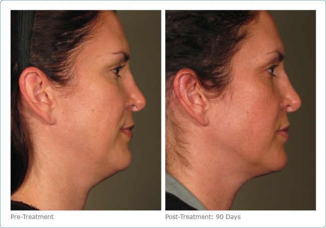 Ultherapy-Before-and-After-4