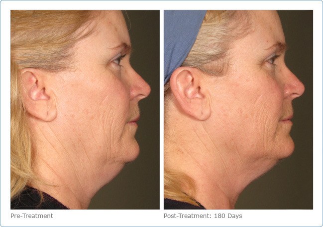 Ultherapy-Before-and-After-5