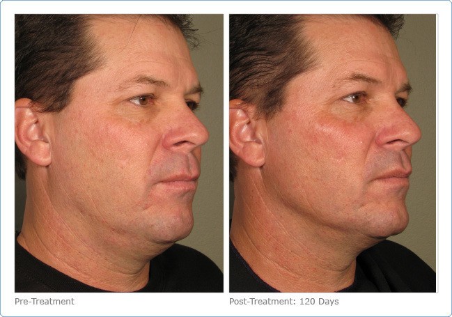 Ultherapy-Before-and-After-7