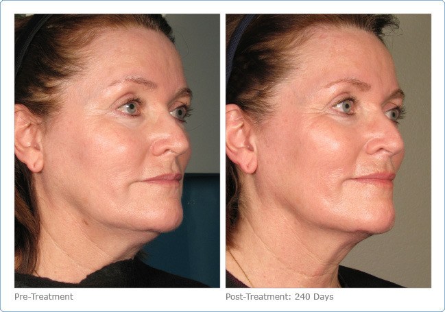 Ultherapy-Before-and-After-8